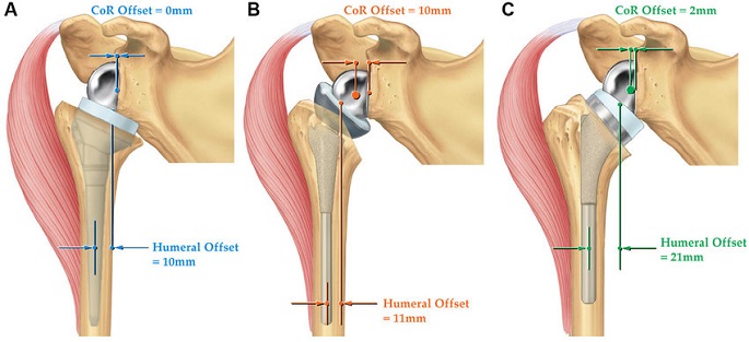 Shoulder Replacement Discharge Instructions